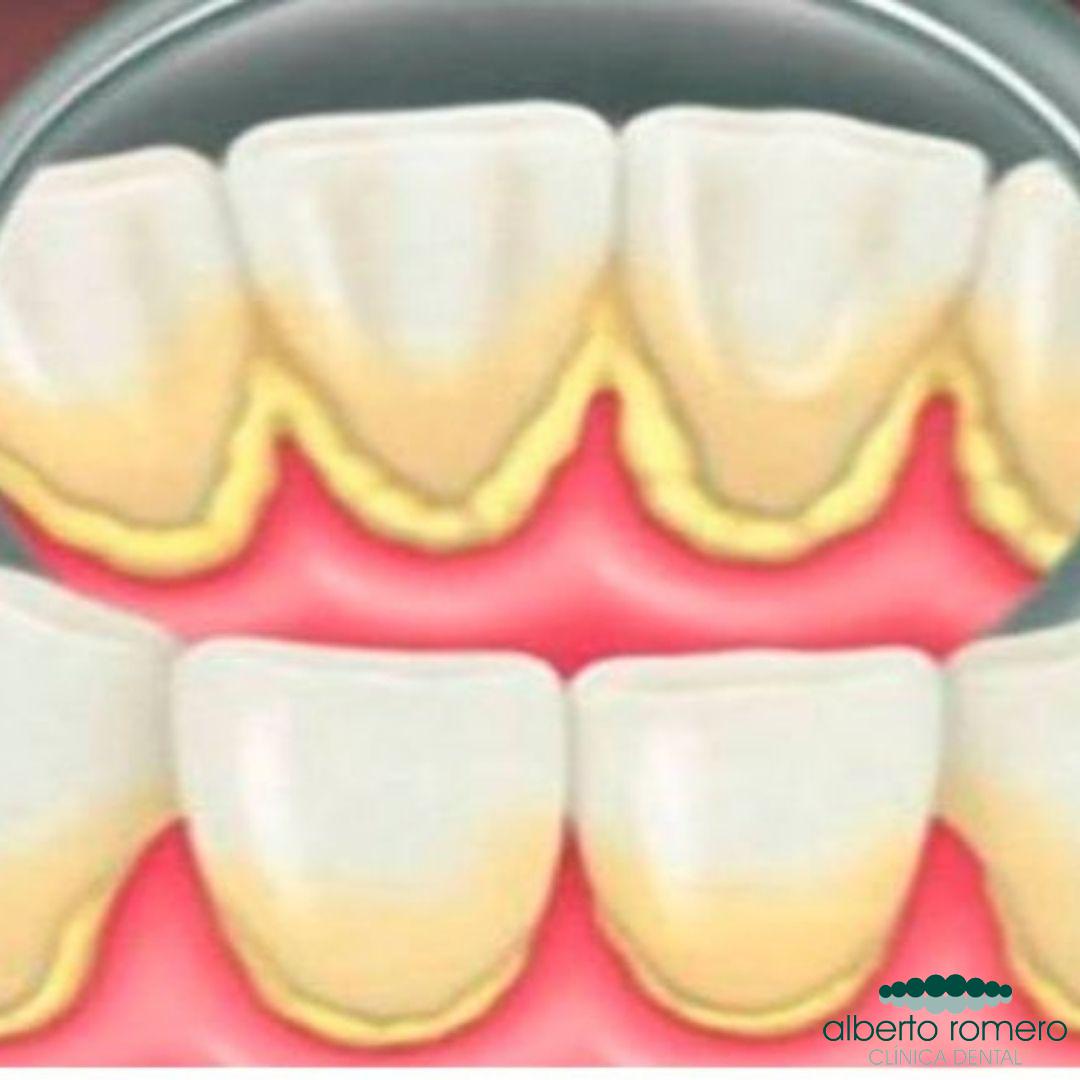 Dureza 鍔 Arrepentimiento Diferencias entre placa bacteriana y sarro dental - Clínica Dental en  Ourense Alberto Romero