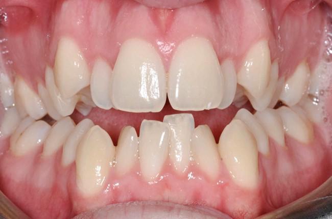 Apiamiento dental: cmo tratarlo? - Foto
