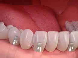 Implantes dentales: �qu� molestias son normales y cu�les no tras un tratamiento? - Foto