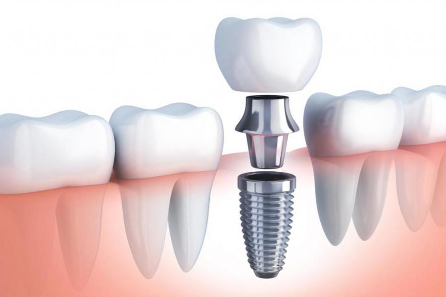 Proceso de un tratamiento de implantolog�a dental - Foto