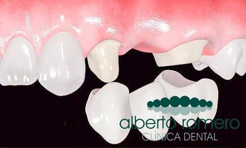 Implantes dentales o puentes dentales: cul es la mejor opcin? - Foto