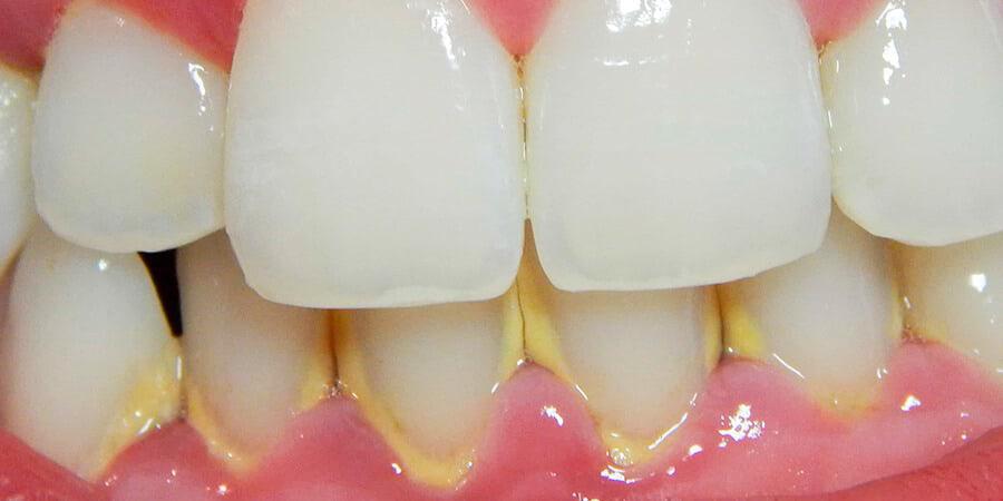 Sarro dental: consecuencias en la salud bucal y prevencin - Foto