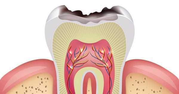 La caries: ms all de la dieta y la higiene bucal - Foto