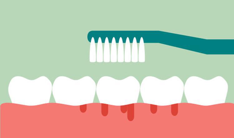 Sangrado de enc�as: �s�ntomas de enfermedad sistem�tica grave? - Foto