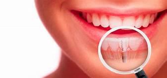 Consejos bsicos para el cuidado de implantes dentales - Foto