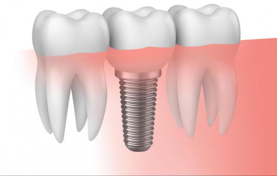 Qu es la periimplantitis? - Foto