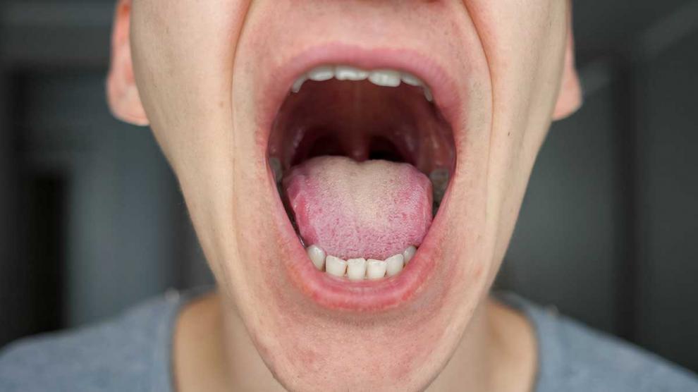 Cncer bucal: causas, sntomas y prevencin - Foto