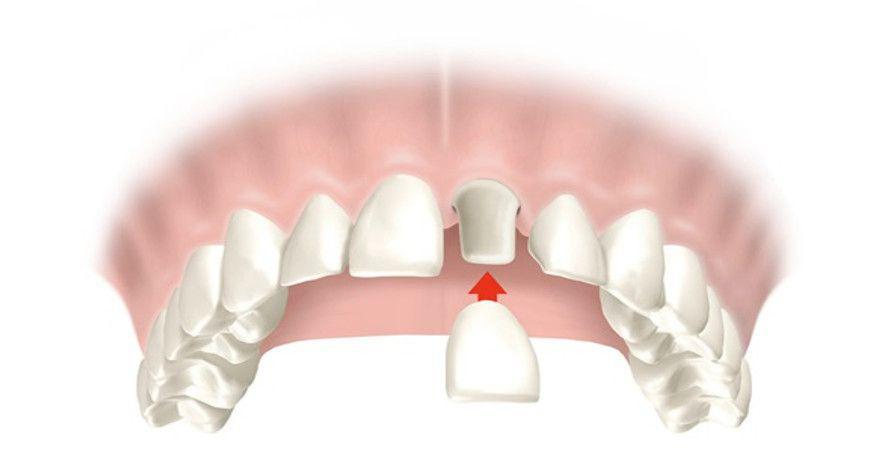 Fundas dentales para proteger dientes debilitados - Foto