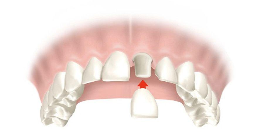 fundas de dientes delanteros