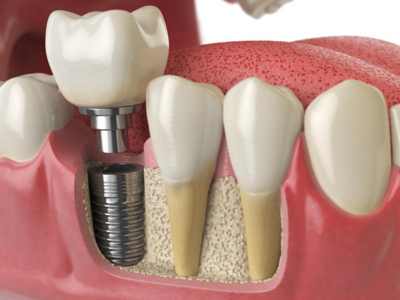 Recuperacin tras la colocacin de implantes dentales - Foto