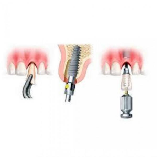 Implantes dentales de carga inmediata: mejores que otros tratamientos? - Foto