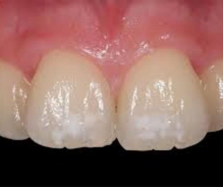 Hipoplasia dental - Foto