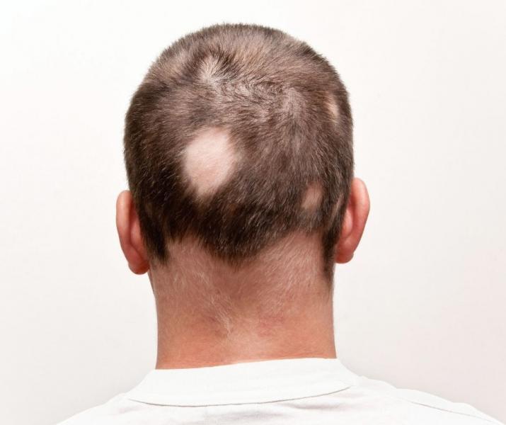 Alopecia areata, sntoma de infeccin bucodental - Foto